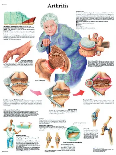Fabrication Enterprises - From: 12-4605L To: 12-4608S - Anatomical Chart arthritis, laminated