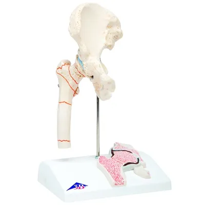 Fabrication Enterprises - From: 12-4577 To: 12-4578 - Anatomical Model Femoral Fracture and Hip Osteoarthritis
