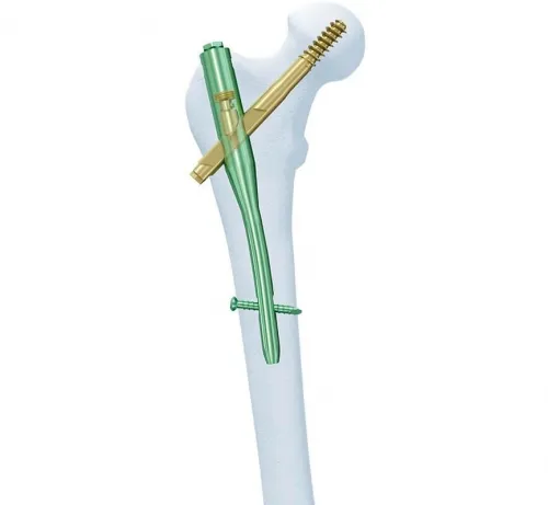 Synthes - 456.415s - Synthes 11mm/130 Deg Ti Cannulated Troch Fixation Nail, 340mm / Left-Sterile